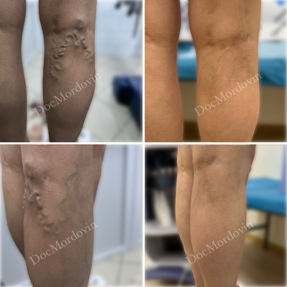 Результат ЭВЛК через 3 месяца