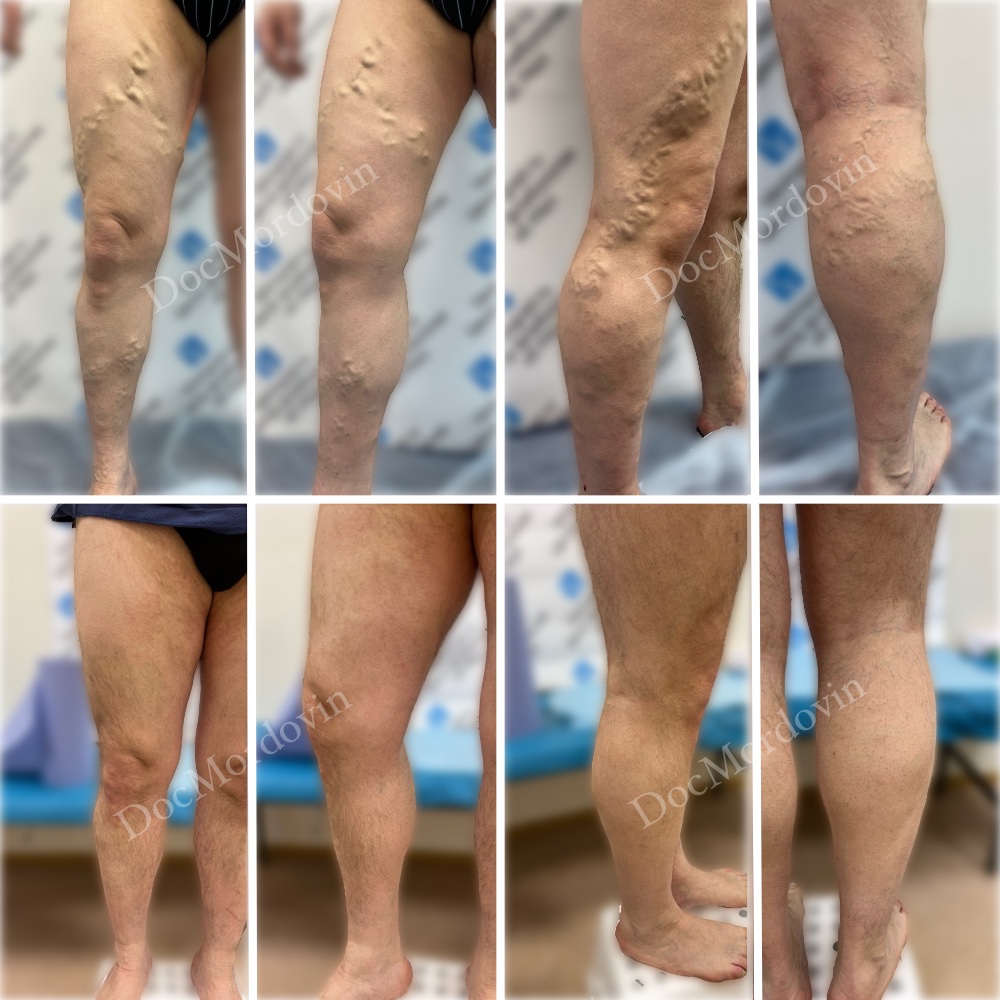 Результат ЭВЛК через 6 месяцев